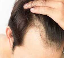 Best Hair Transplant Surgeon Hyderabad