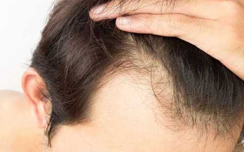 Best Hair Transplant Surgeon Hyderabad