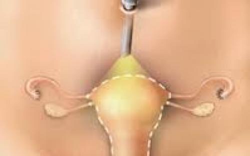 hysterectomy 