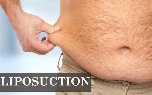 liposuction