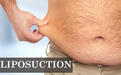 liposuction